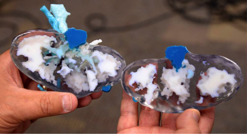 3-D printing helped to spare a kidney for this patient